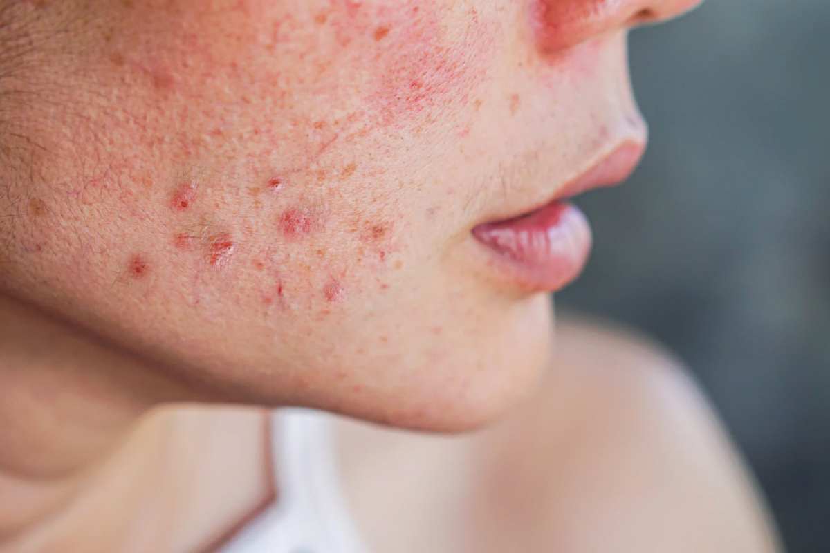 acne come risolvere
